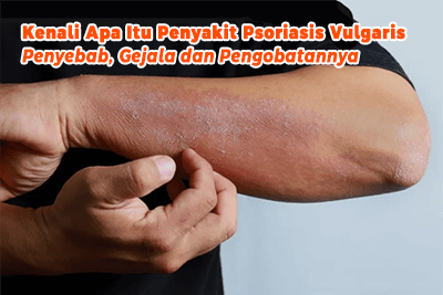 Kenali Apa Itu Penyakit Psoriasis Vulgaris, Penyebab, Gejala dan Pengobatannya